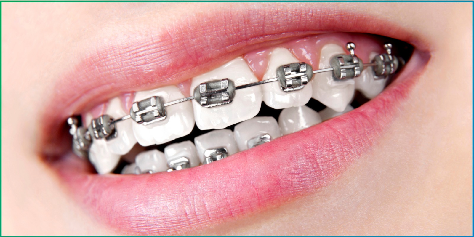 Dental Braces Treatment in Pune Diagnopein Dental Clinic